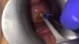 Экстремальная гинекологическая игра шейки матки - порно видео